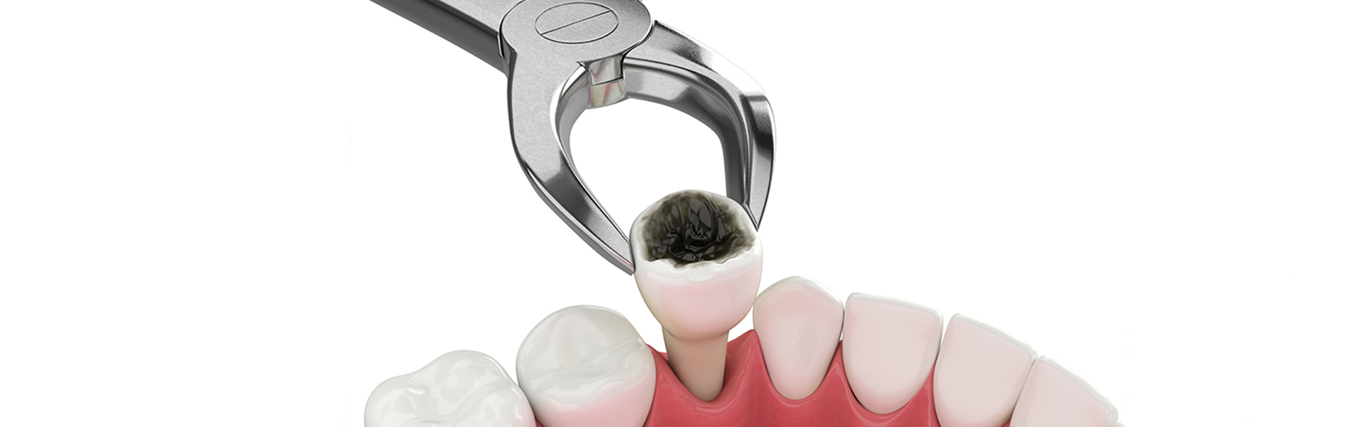 Which Teeth Are the Hardest to Pull Out? A Dentist’s Guide